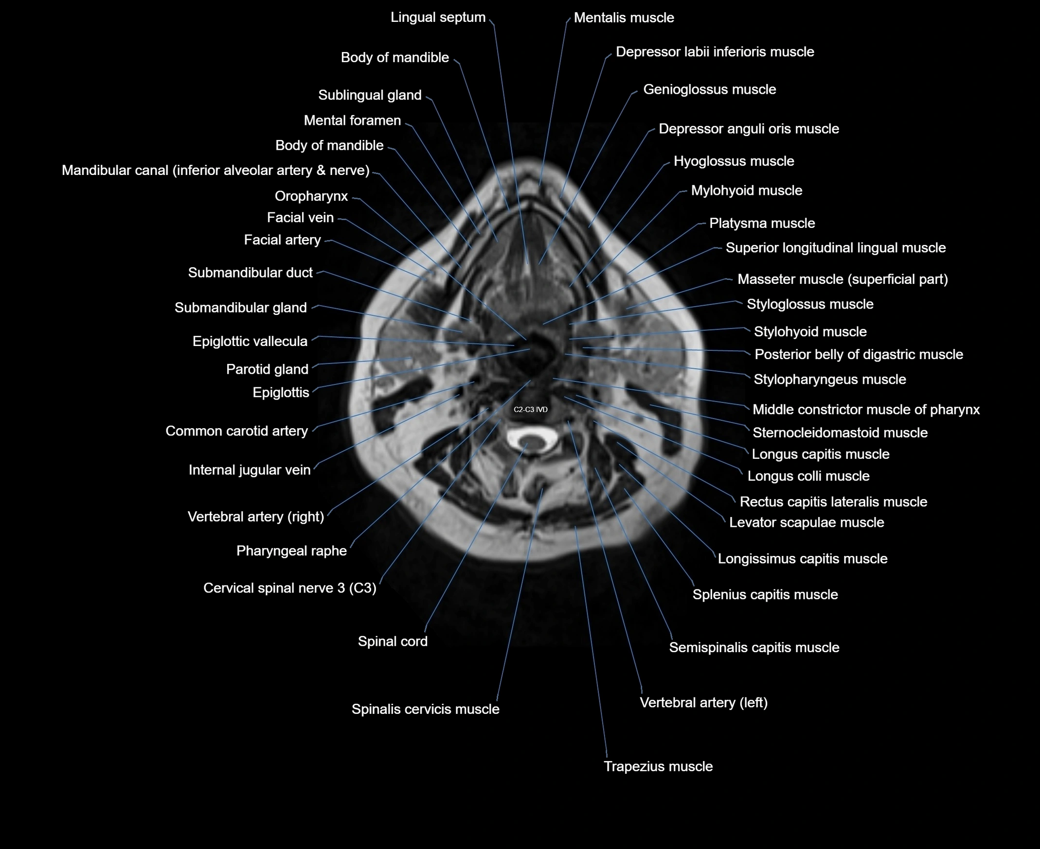 MRI Neck 3D labelled cross section anatomy axial 3t image-00001-00041.webp